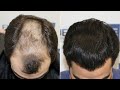 FUE Hair Transplant (3218 Grafts in Diffuse Pattern) Dr. Juan Couto - FUEXPERT CLINIC- Madrid, Spain