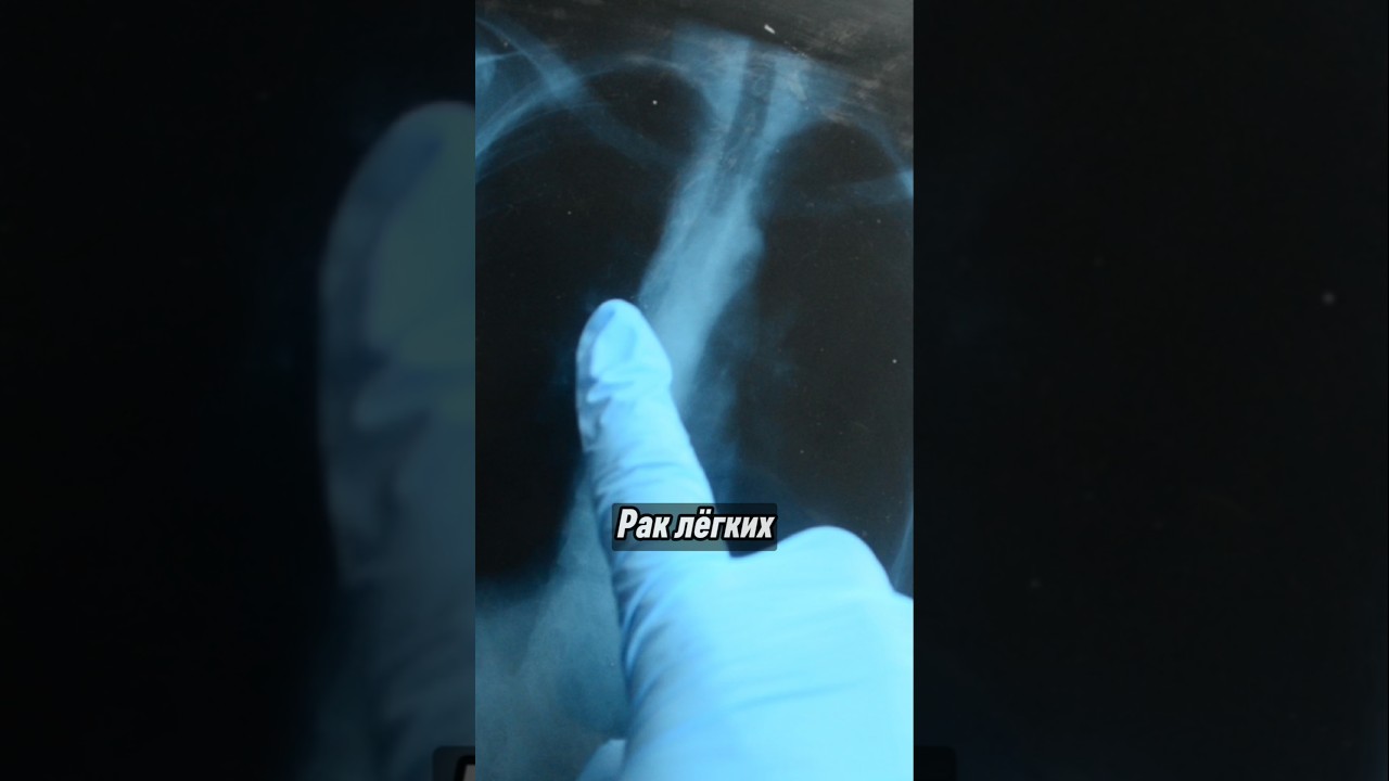 Первые признаки рака лёгких🚨 #здоровье #рак #онкология