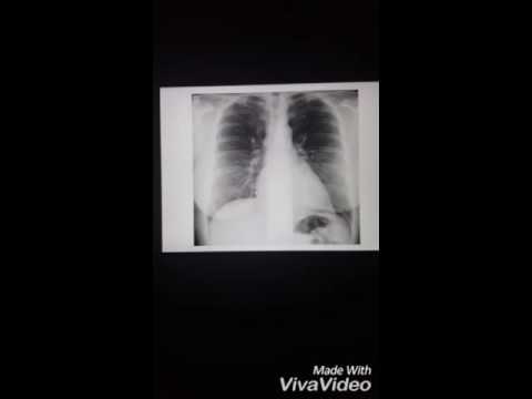 فيديو: هل ستظهر الأشعة السينية على الصدر انسدادًا رئويًا؟