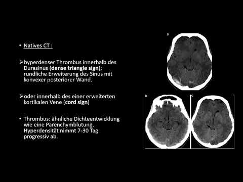 Zerebrale venöse Thrombose/Sinusvenenthrombose/Radiologie