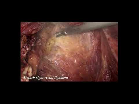 Laparoscopic Posterior Pelvic Viscerectomy for Anal Squamous Cell Carcinomas with Anovaginal Fistula