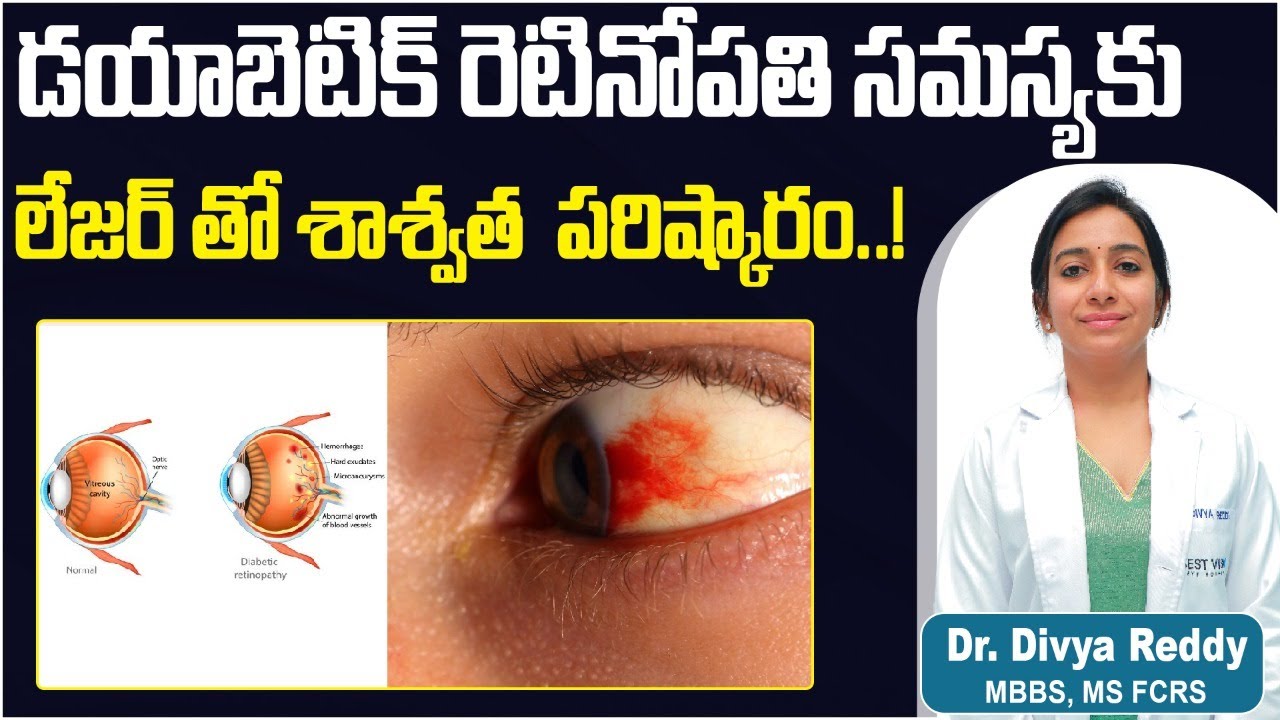 కంటి నుండి రక్తం కారుతుందా || Diabetic Retinopathy Treatment in Telugu || Best Vision Eye Hospital