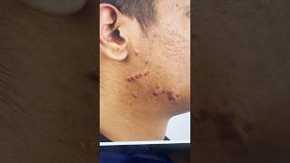 Multiple Keloids in the FACE removed with fine plastic surgery