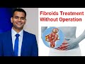 Utrine Fibroids Treatment Without Operation.