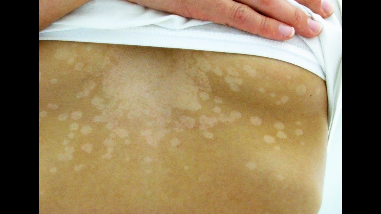 Post Inflammatory Hypopigmentation Natural Treatment Post Inflammatory Hypopigmentation Natural Treatment