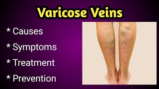 Varicose Veins Causes, Symptoms and Treatment .