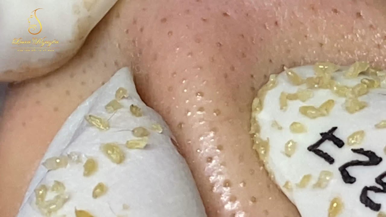 Loan Nguyen Acne Treatment (#123)