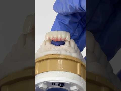 Lower Anterior Zirconia