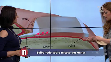 Quais tratamentos podem ser indicados para onicomicose?