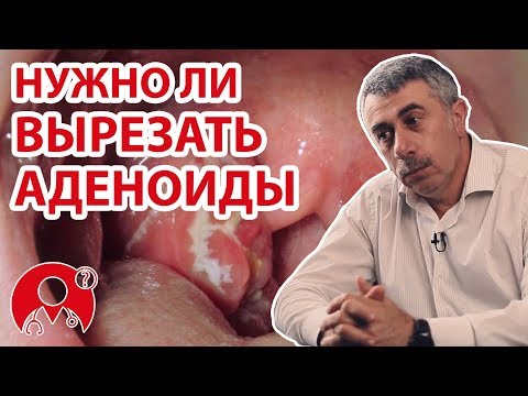 Нужно ли вырезать аденоиды? | Вопрос Доктору