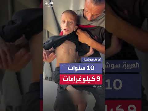 طفل غزيّ يبلغ من العمر 10 سنوات يعاني من سوء تغذية حاد
