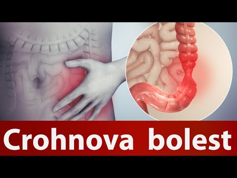 Crohnova bolest  Dr#71