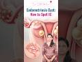 Ovarian Cysts vs Endometriosis | Can Cysts Affect Pregnancy? | Dr. Sahithi Balmuri