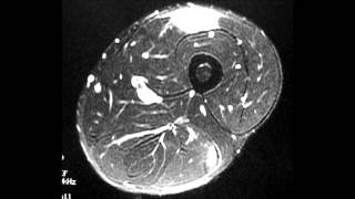 Results of Repair of Rectus Femoris Musculotendinous Tear by Dr HC Chang screenshot 2