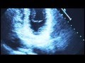 Living with Mitral Valve Prolapse