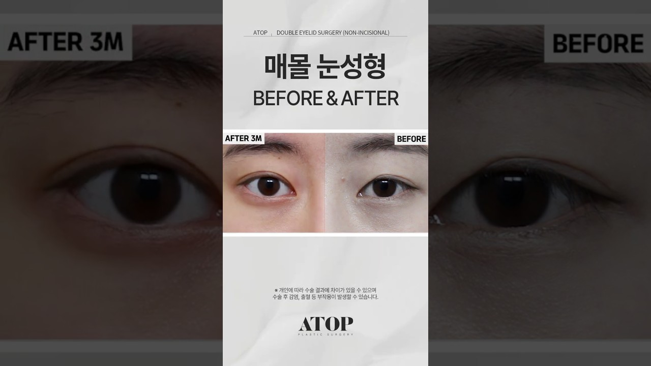 [A-TOP Phẫu thuật thẩm mỹ] Nâng mí mắt nữ chôn chỉ_Đánh giá 4