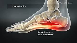 Plantar Fasciitis Surgery  Symptoms Treatment Causes  Risk