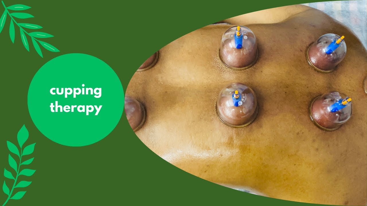 cupping therapy for spine pain & cervical pain - YouTube