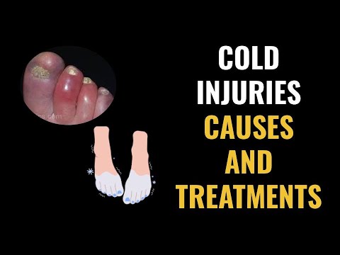 Cold Injuries Causes and Treatments