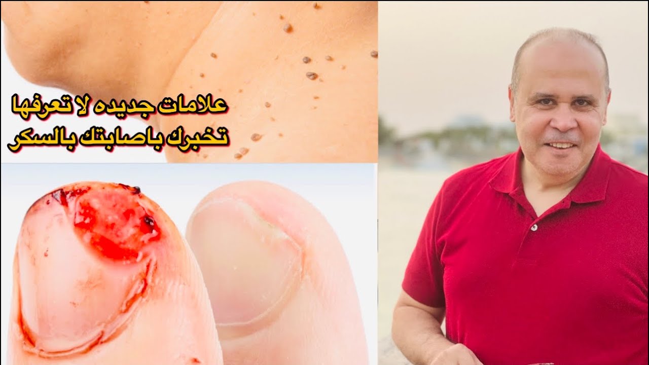 طريقه سهله وبدون تحليل وعلامات خطيره في جسمك هتعرف اذا كنت مصاب بالسكر