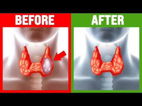 How to Shrink Thyroid Nodules Naturally - Dr. Berg