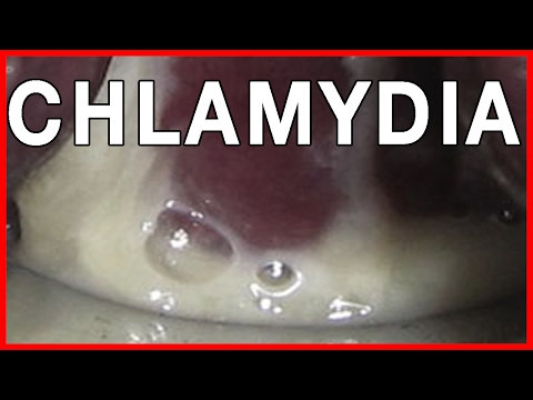 How To Cure Chlamydia In Men? Pictures, Symptoms And Treatment