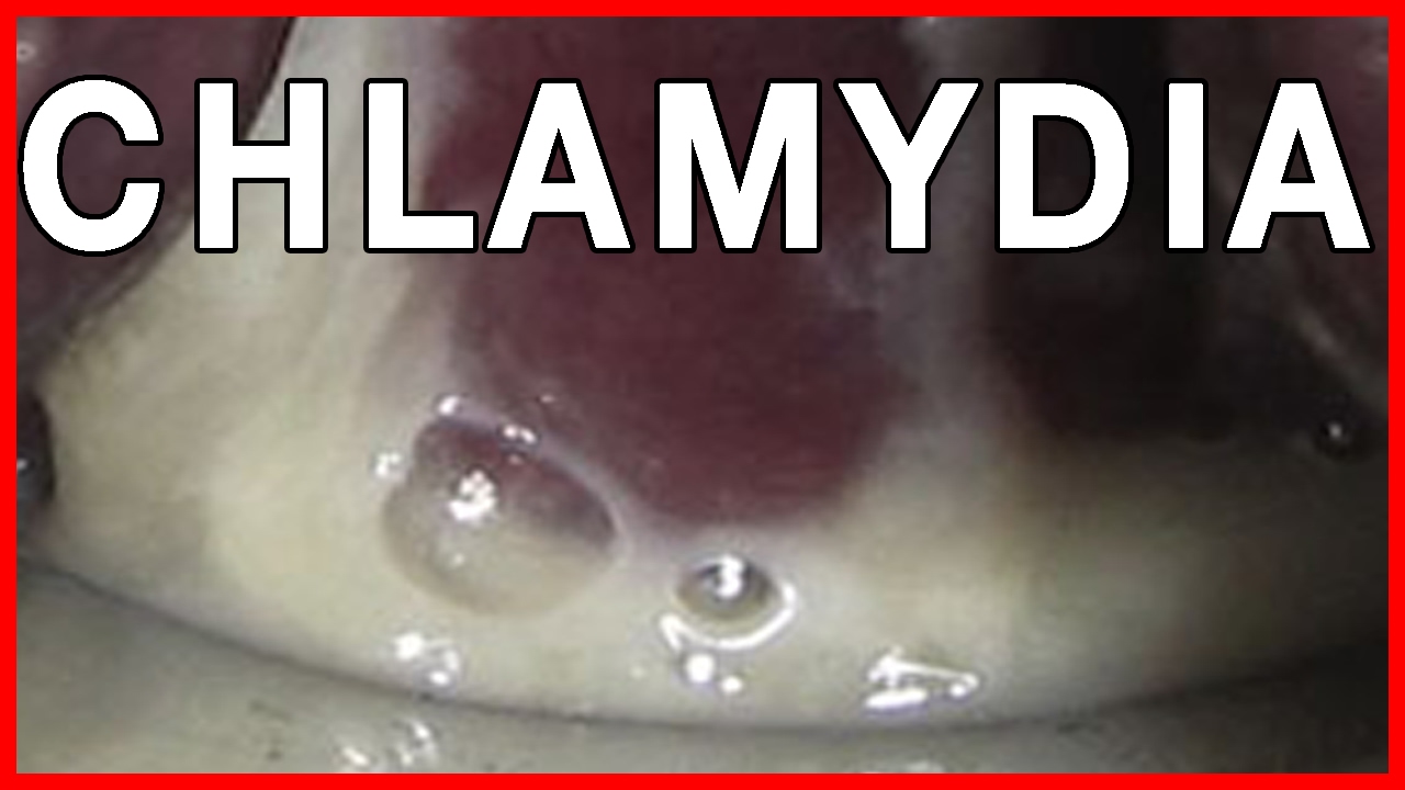 How to Cure Chlamydia in Men? Pictures, Symptoms and Treatment - YouTube