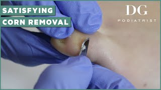 Satisfying corn removal on pinky toe | The Foot Scraper: DG Podiatrist