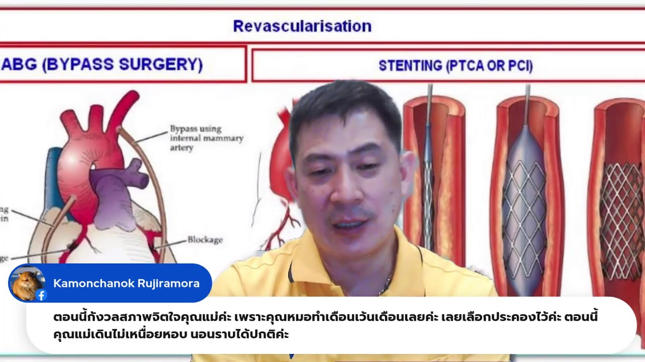 หลอดเลือดหัวใจตีบ หลังใส่ขดลวด บายพาส ดูแลตัวเองอย่างไรดี LIVE จันทร์ 24 ก.ค.2566 คุยกับหมอหัวใจ