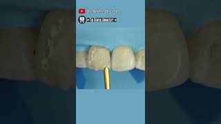 Restoring Patient's Confidence #dental #toothfilling #dentist #toothrestoration #dentistry