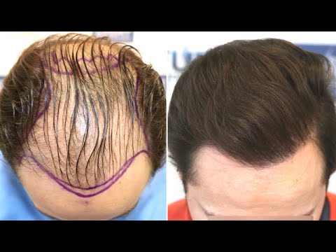 How much does 3000 grafts cost  BlueMagic Clinic
