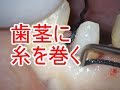 歯茎に糸の埋入