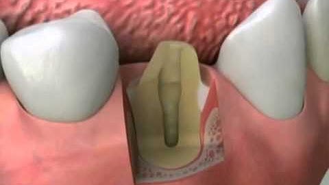 River Road Dental: Cast Post Core