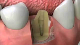 River Road Dental: Cast Post Core