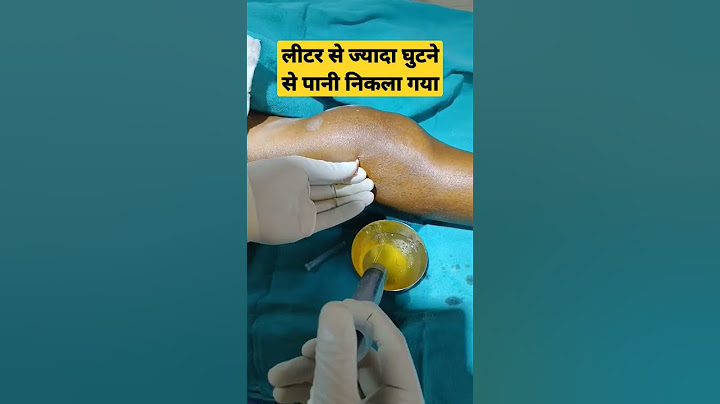 1 लीटर से ज्यादा पानी घुटने से खींच के निकाला गया | #effusion #swelling #kneearthritis #kneepain |