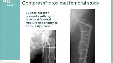 COMPRESSIVE OSSEOINTEGRATION OF PROXIMAL FEMORAL AND DIVERSE ANATOMIC LOCATIONS