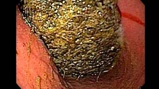 Hiperemia localización de definición