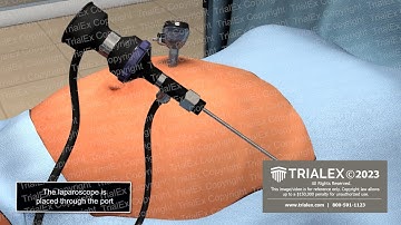 Insertion of Laparoscopic Trocar Animation