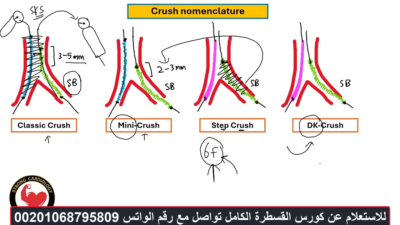 Coronary Crush Bifurcation stenting, Dr Alaa Nasr, 2025