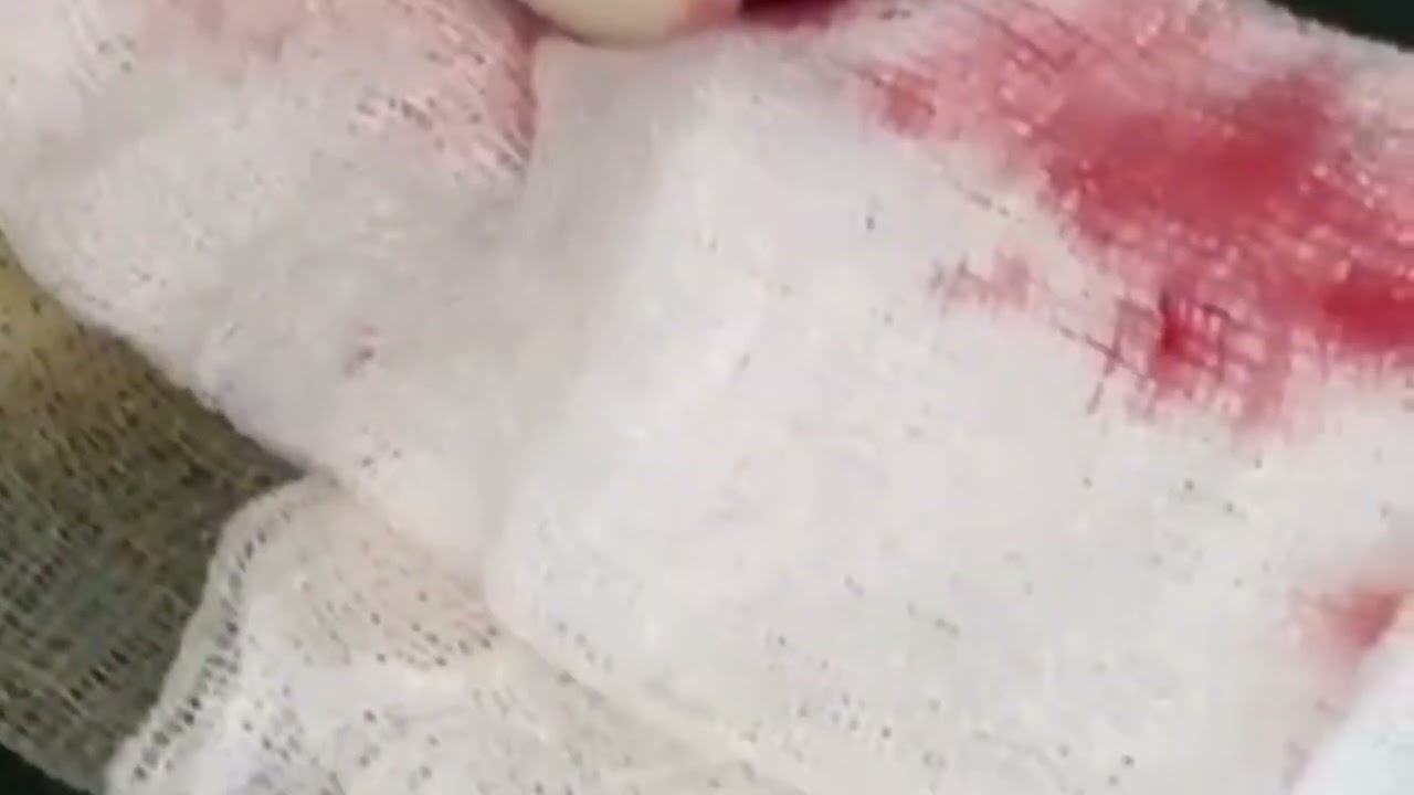 Urinary bladder calculii