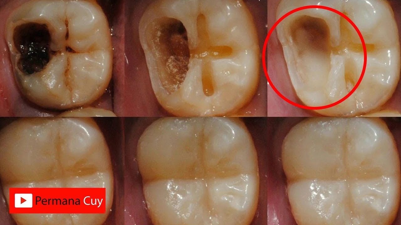 Tak Perlu Ke Dokter Gigi  Cukup Dengan Ini Atasi Sakit 