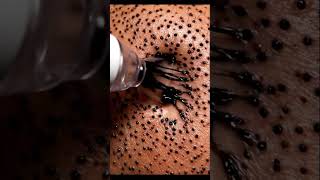 Massive Nose Blackhead Suction | Realistic ASMR Clean-Up #satisfying #blackheadcaique #skincare