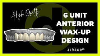 6 Unit Anterior Wax-Up Design in 3Shape | Premium Dental CAD by Dentcruze