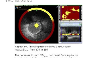 Changing Stenting Strategy Based on NIRS-IVUS Data from TVC Imaging System