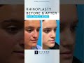 Aesthetic and Functional Rhinoplasty at 1 Month 👃🤩 | Dr. Becker
