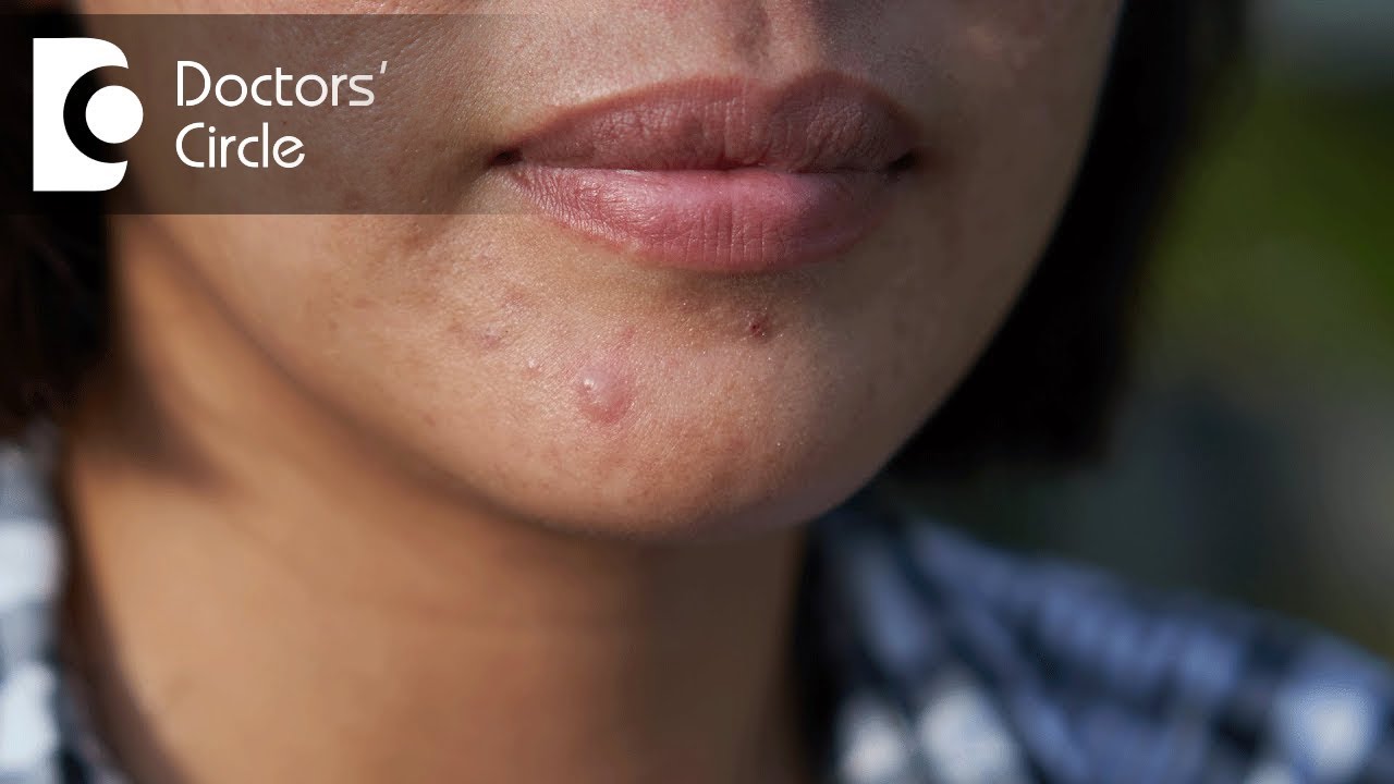 Can creatine monohydrate supplement lead to Acne? - Dr. Rasya Dixit