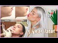MY CHIN FILLER EXPERIENCE | 1 YEAR LATER with before & after pictures | Is it really worth it?