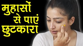How to apply Haldi on Face to Remove Pimples - मुहांसों को दूर करने के लिए चेहरे पर हल्दी कैसे लगाएं