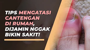 Lima Cara Ampuh Mengatasi Cantengan Tanpa Rasa Sakit