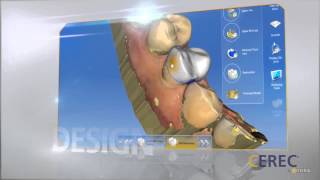 CEREC Technology at Advanced DDS